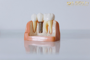 All-on-4 Dental Implants