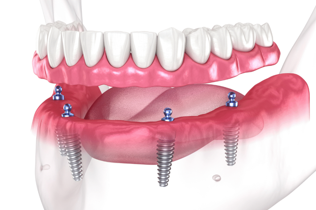 Different Types of Dental Implants