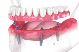 Different Types of Dental Implants
