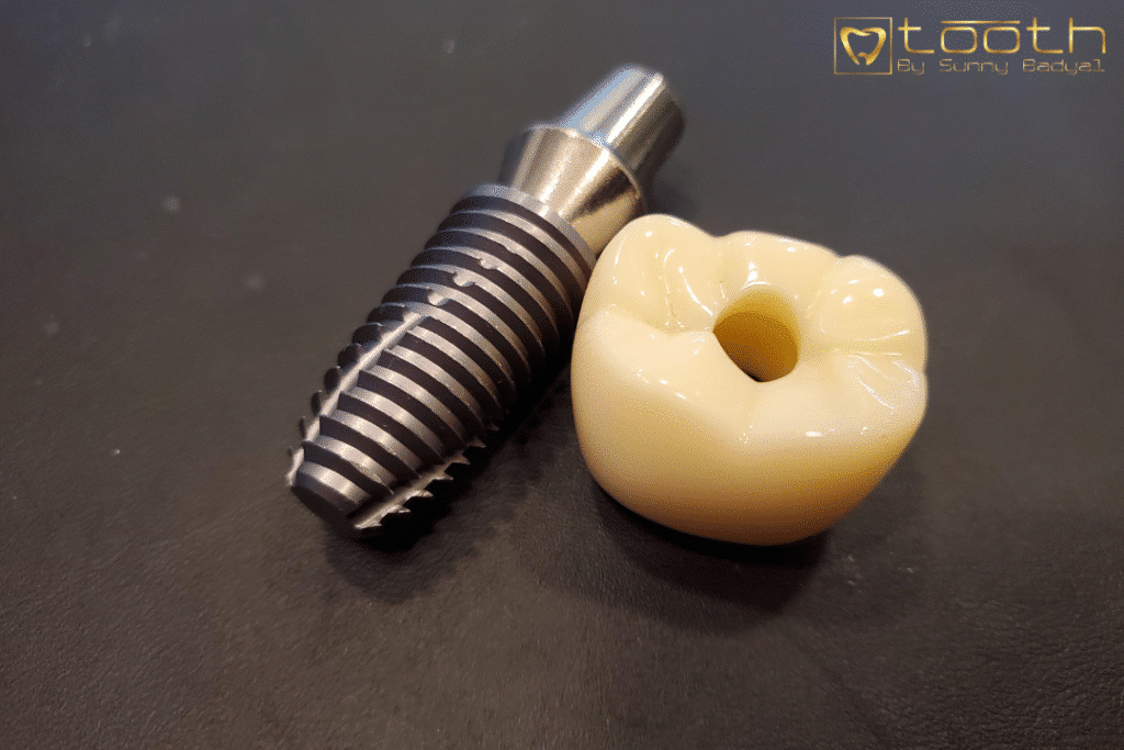 Types of Dental Implants