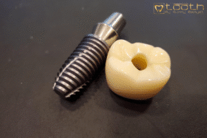 Types of Dental Implants