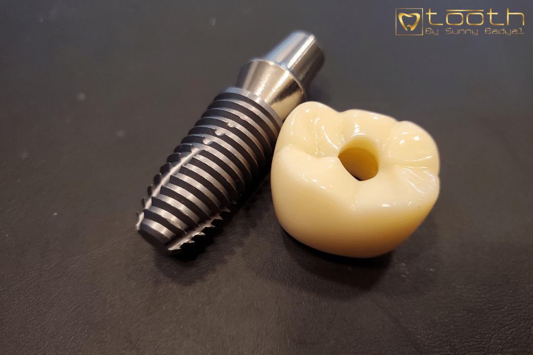 Types of Dental Implants
